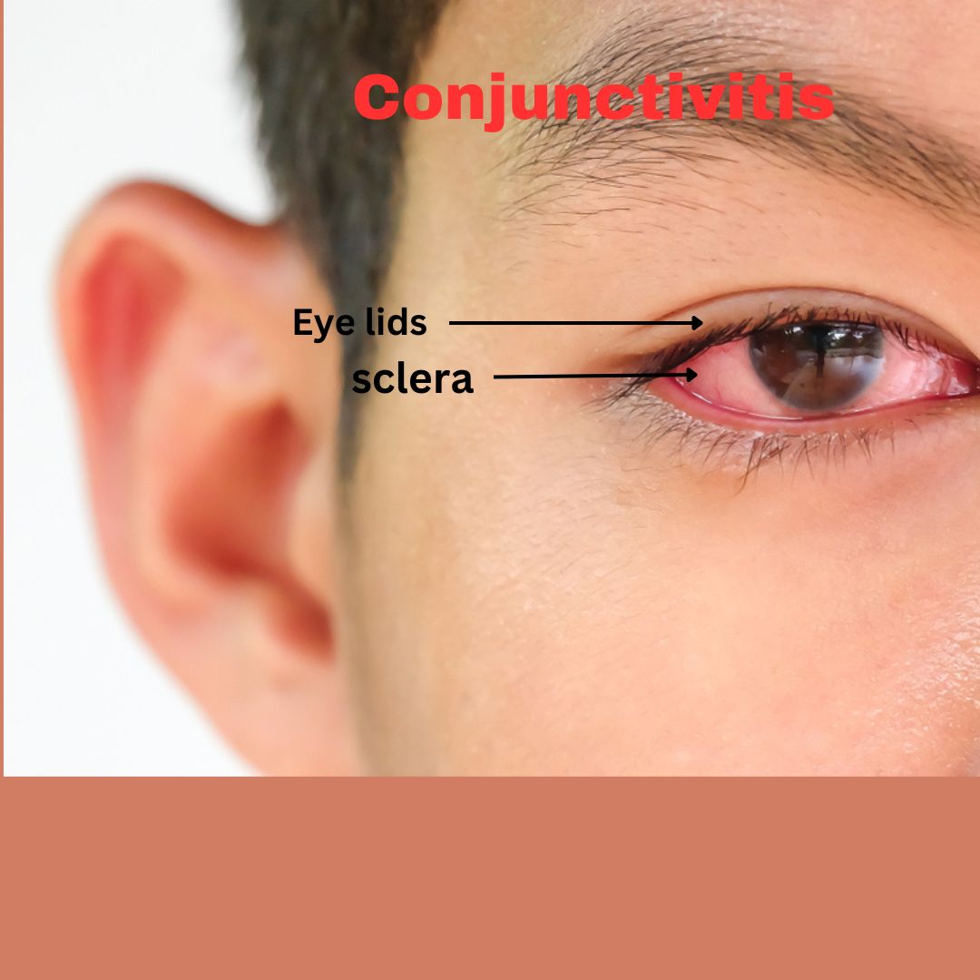 CONJUCTIVITIS