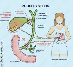 Acute cholecystitis