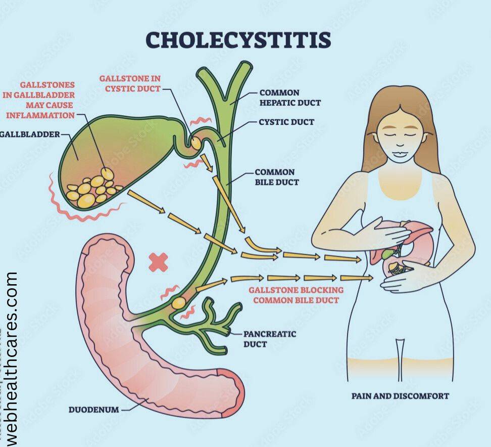 Acute cholecystitis :- About, Causes, Symptoms, Test, Treatment