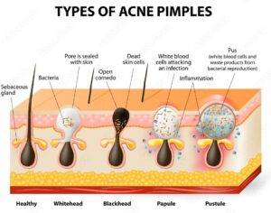 types of pimples