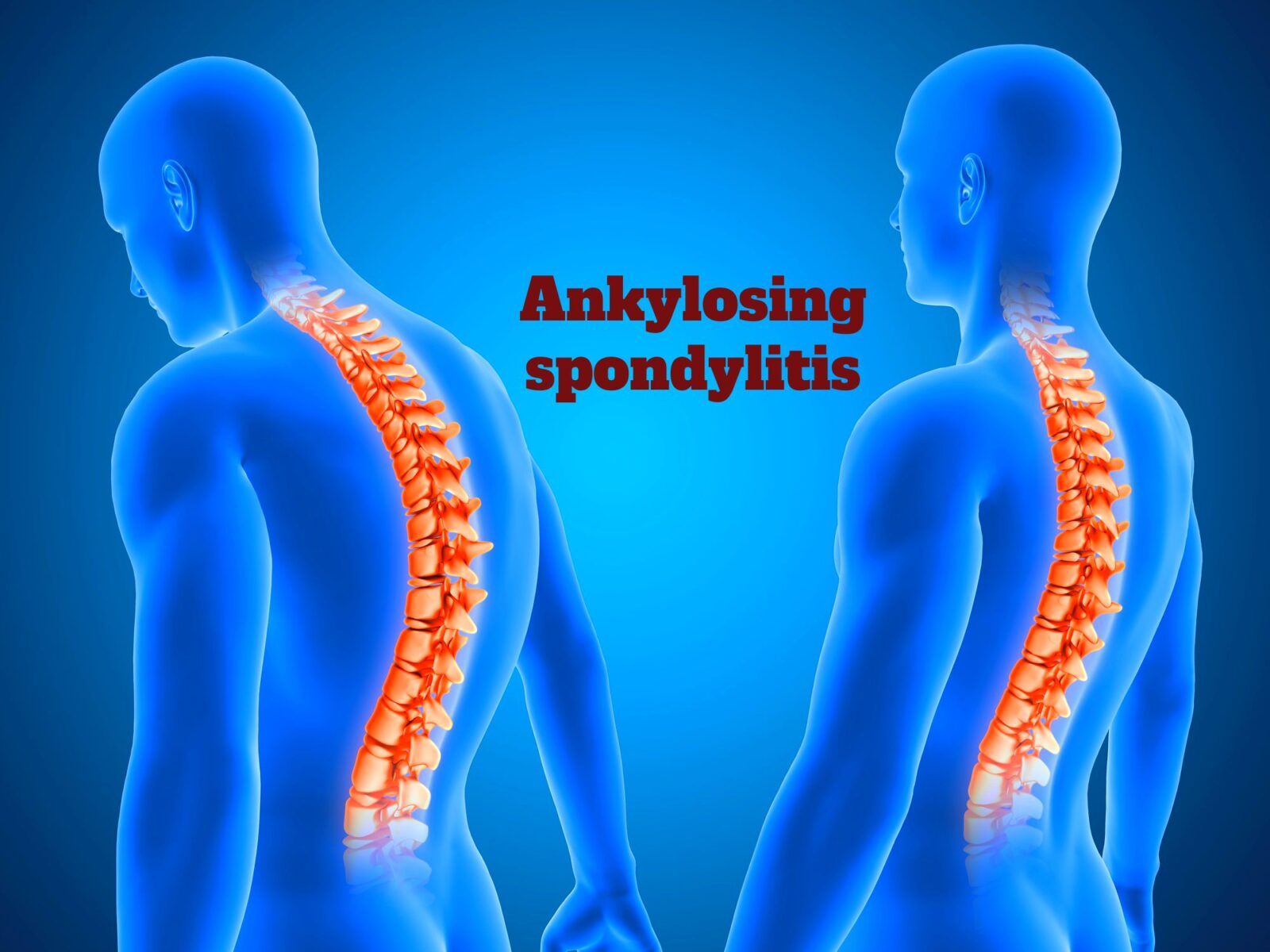 Ankylosing Spondylitis Causes Symptoms Test Treatment And Ayurveda Medicine