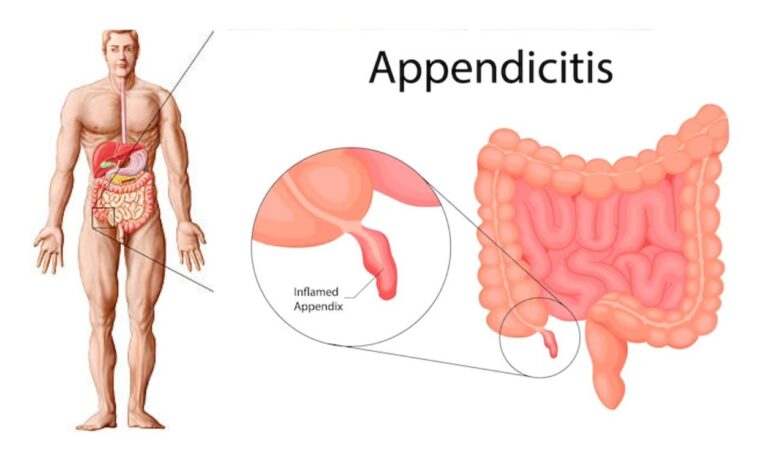 Appendicitis