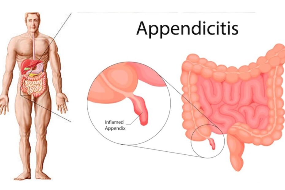 Appendicitis