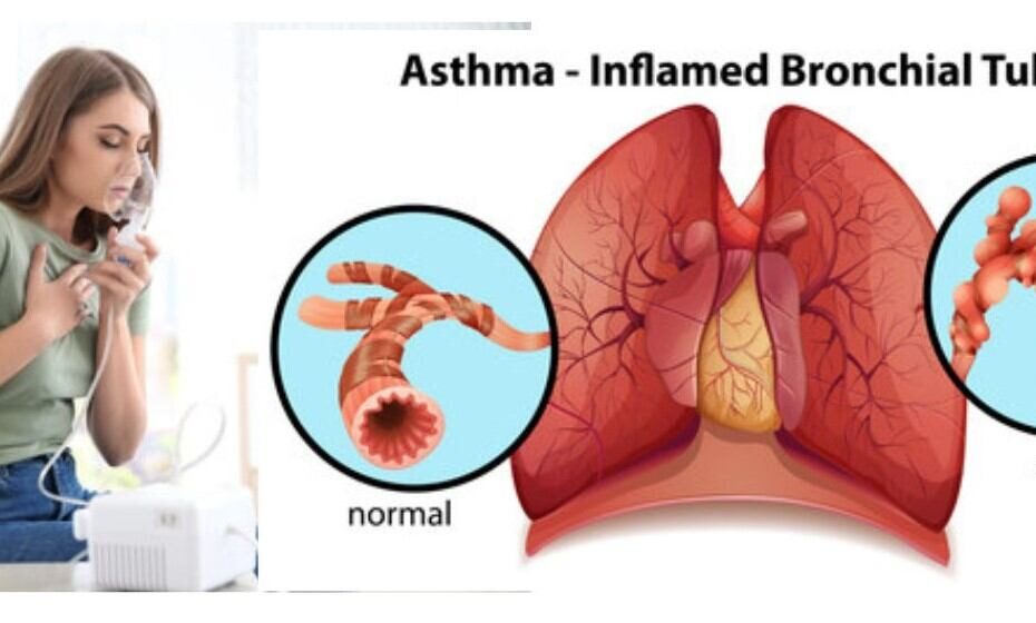 Asthma : Symptoms, Test, Treatment, Avoid Food, Ayurveda Medicine.