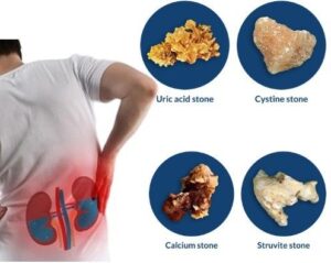 types of kidney stones